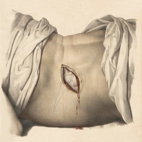 Anatomische Zeichnung eines geöffneten Bauches mit sichtbarer Blutung und chirurgischen Nähten, von Tüchern umrahmt.