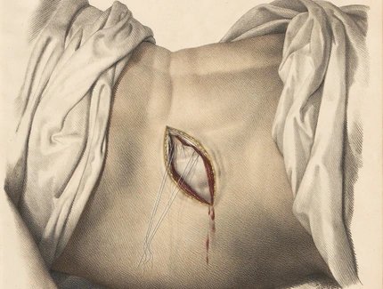 Anatomische Zeichnung eines geöffneten Bauches mit sichtbarer Blutung und chirurgischen Nähten, von Tüchern umrahmt.